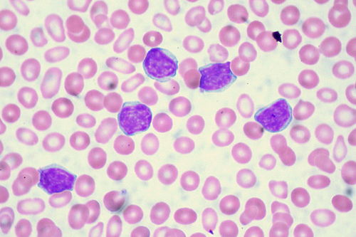 Leukemia - Crew Member Medical Treatment